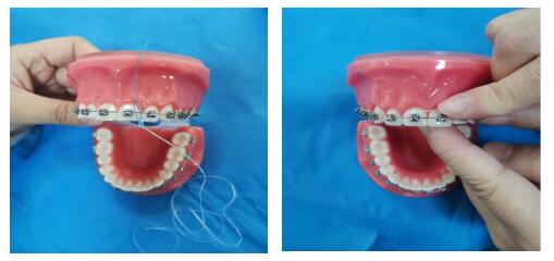 牙齿矫正期间如何控制牙菌斑？教你洁齿方法