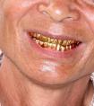 金牙可导致老人牙龈病加重要引起注意