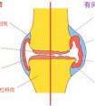 老人骨关节痛的原因及缓解方法