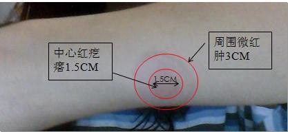 一次头孢过敏 以后还能用这类药吗