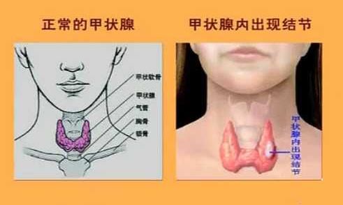 多发性甲状腺结节 患者应该如何科学治疗