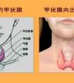 多发性甲状腺结节 患者应该如何科学治疗